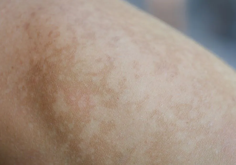 Sun Damage & Uneven Skin Tone care at Revita Luxe Tampa