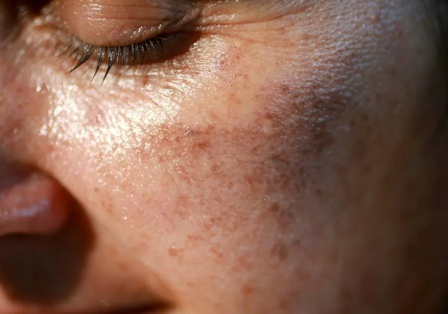 Sun Damage and Uneven Skin Tone — conditions we treat at Revita Luxe