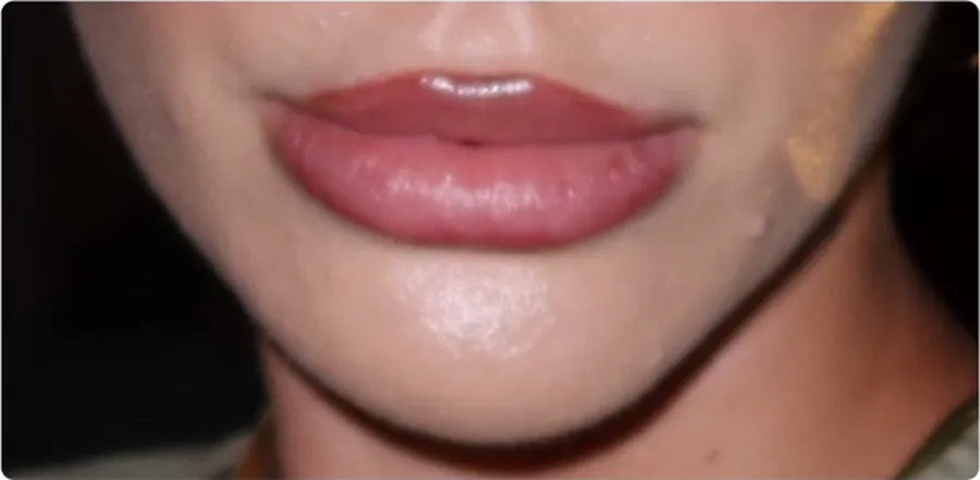 Lips before and after dermal filler — before