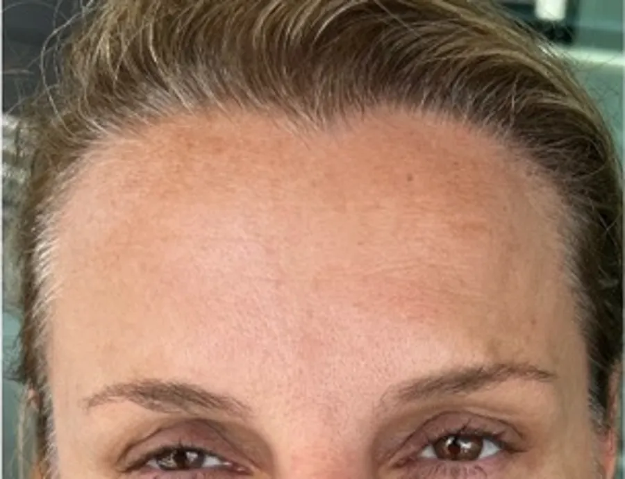 Forehead with horizontal lines before, and smoother forehead after, Botox treatment — after