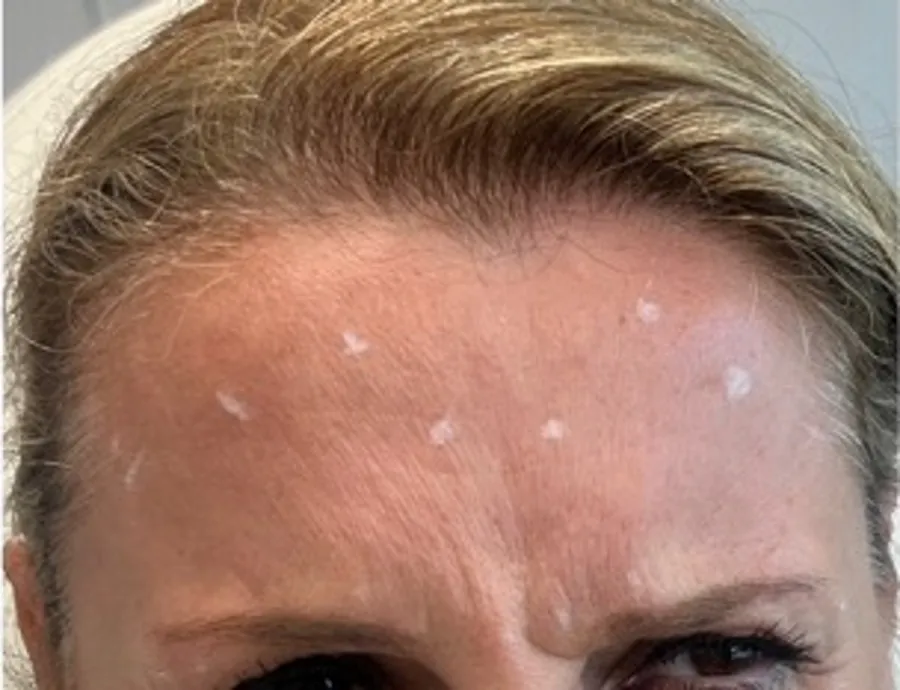 Forehead with horizontal lines before, and smoother forehead after, Botox treatment — before