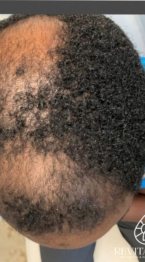 Top of the scalp with thinning at the part line before, and denser coverage after, hair restoration — before