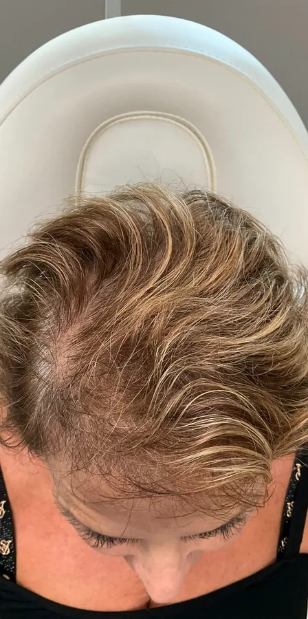 Light hair thinning at the part before and fuller after hair restoration — after