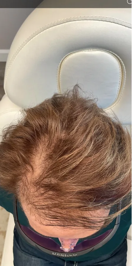 Light hair thinning at the part before and fuller after hair restoration — before