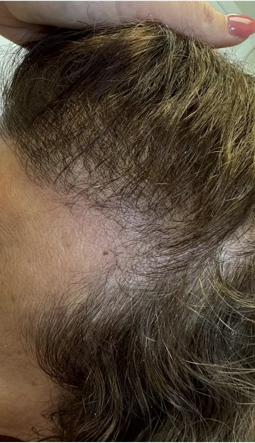 Receding temple before and regrowth along the hairline after hair restoration — before