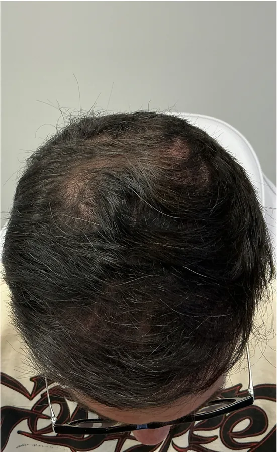 Sparse crown before and fuller crown after hair restoration — after