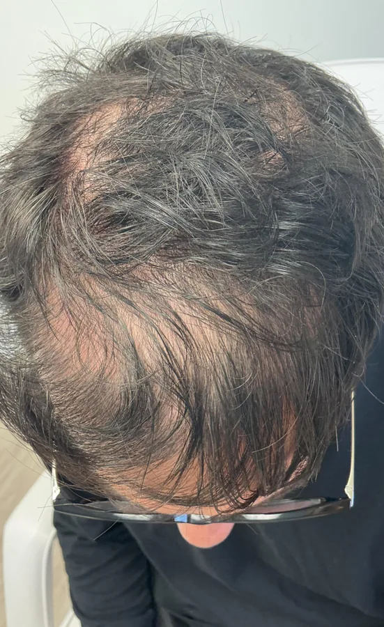 Sparse crown before and fuller crown after hair restoration — before