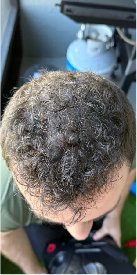 Receding front hairline before and denser frontal hair after hair restoration — after