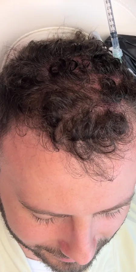 Receding front hairline before and denser frontal hair after hair restoration — before