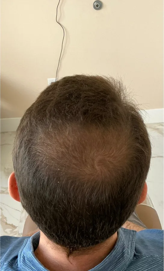 Bald spot at the crown before, and coverage after, hair restoration — after