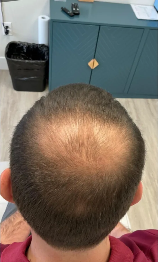 Bald spot at the crown before, and coverage after, hair restoration — before
