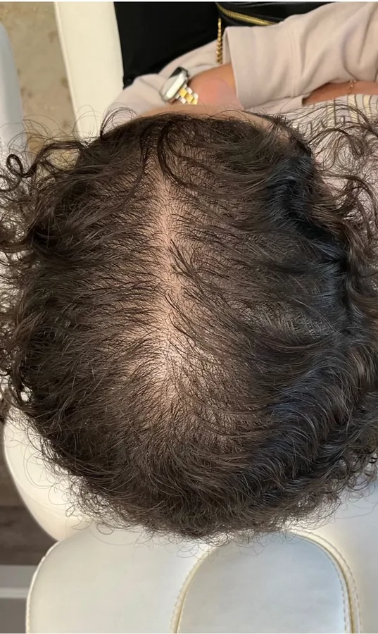 Wide part line before and narrower part after hair restoration — after