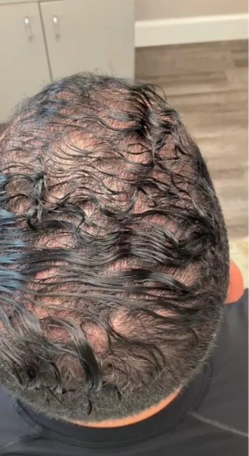 Curly hair at the crown before and after hair restoration — before