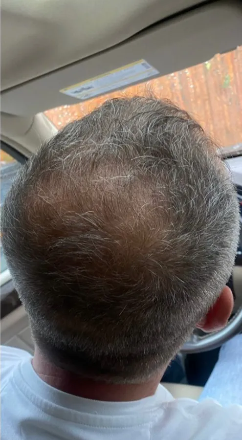 Bald patch at the crown before, and regrowth across the crown after, hair restoration — after