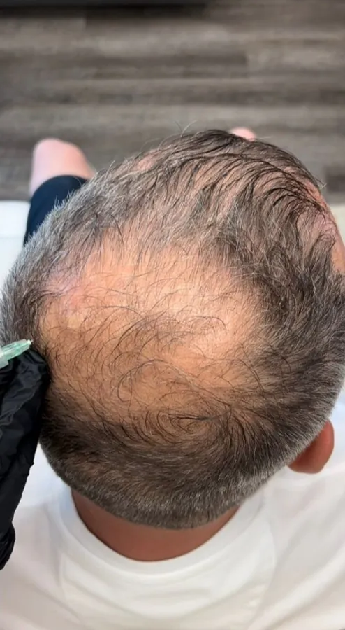 Bald patch at the crown before, and regrowth across the crown after, hair restoration — before