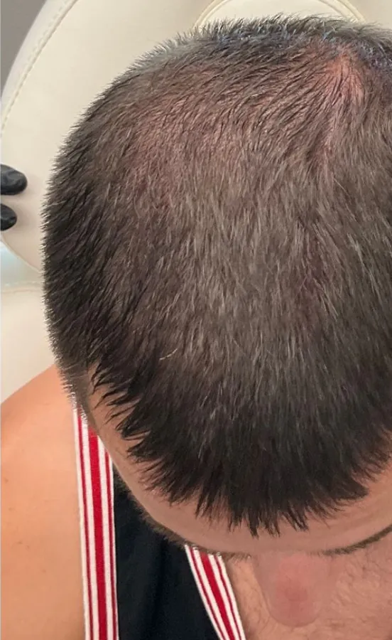 Thinning at the front of the scalp before and after hair restoration — after
