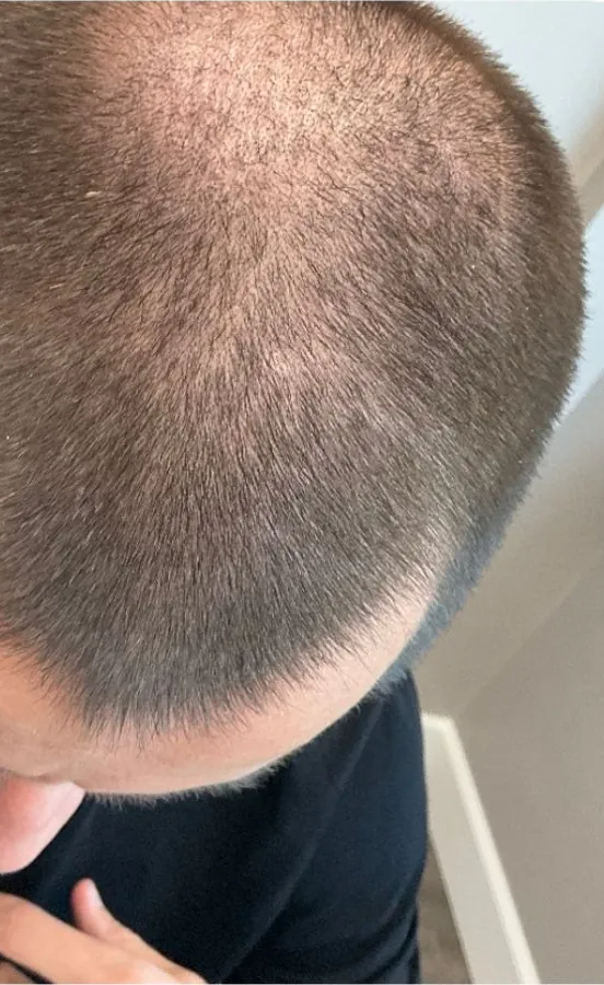 Thinning at the front of the scalp before and after hair restoration — before