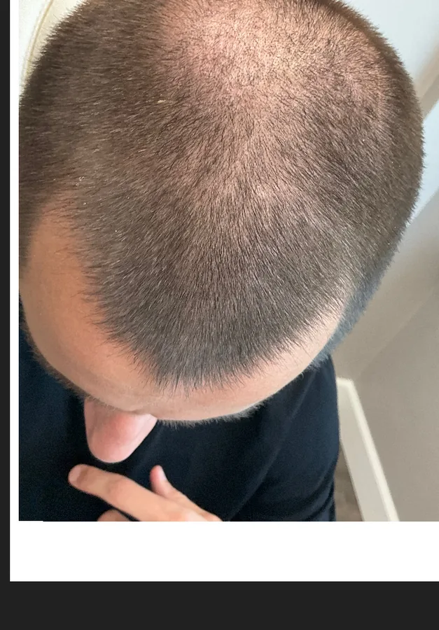 Thinning crown and front before, and thicker coverage after, hair restoration — before