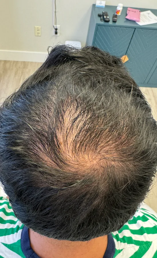 Thinning crown before and denser crown after hair restoration — before