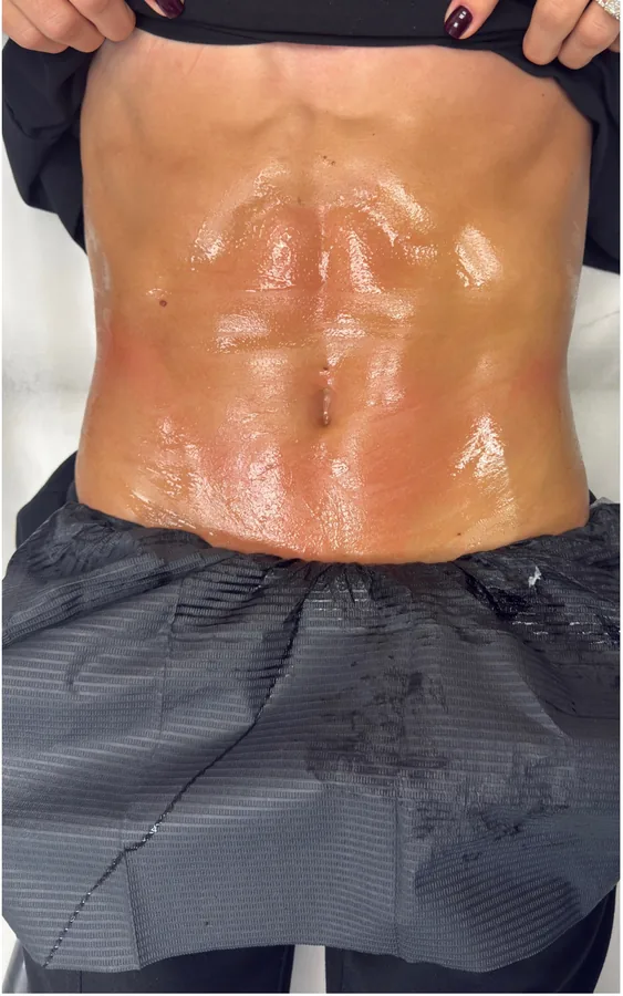 Abdomen before and after T-Shape 2 body contouring treatment — after