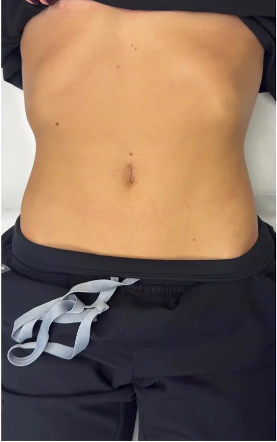 Abdomen before and after T-Shape 2 body contouring treatment — before