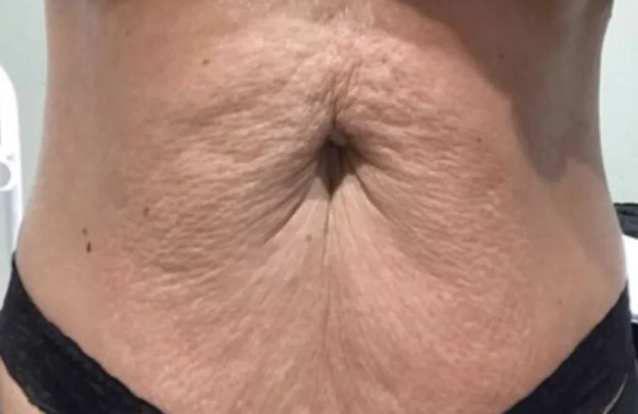Loose, creased skin across the abdomen before, and smoother, tighter skin after, T-Shape 2 body contouring — before