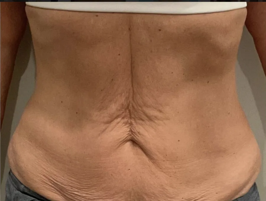 Creased, loose skin across the lower back before, and firmer, smoother skin after, T-Shape 2 body contouring — before